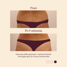Résultats avant et après liposuccion à InSense Clinic, amélioration visible de la taille