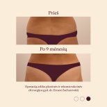 Résultats avant et après liposuccion à InSense Clinic, amélioration visible de la taille
