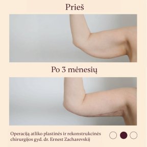 Résultats lifting des bras (brachioplastie) avant/après à InSense Clinic (SV Plastic Surgery Clinic)