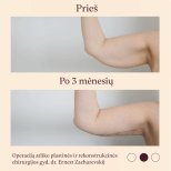 Résultats lifting des bras (brachioplastie) avant/après à InSense Clinic (SV Plastic Surgery Clinic)