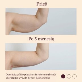 Résultats avant et après lifting des bras (brachioplastie) à InSense Clinic (SV Plastic Surgery Clinic)