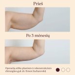 Résultats avant et après lifting des bras (brachioplastie) à InSense Clinic (SV Plastic Surgery Clinic)