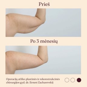 Résultats avant/après lifting des bras à InSense Clinic, contour du bras amélioré
