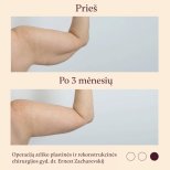 Résultats avant/après lifting des bras à InSense Clinic, contour du bras amélioré