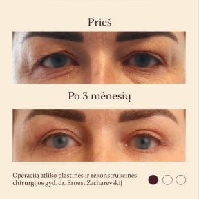 Блефаропластика до і після в InSense Clinic (SV Plastic Surgery Clinic), підтяжка повік