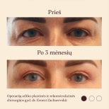 Блефаропластика до і після в InSense Clinic (SV Plastic Surgery Clinic), підтяжка повік