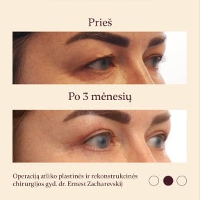 Блефаропластика до і після в InSense Clinic (SV Plastic Surgery Clinic), корекція повік