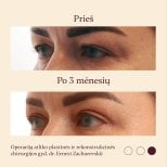 Блефаропластика до і після в InSense Clinic (SV Plastic Surgery Clinic), результат через 3 місяці