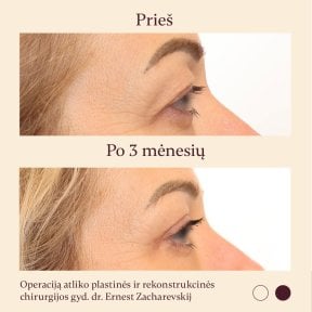 Результати блефаропластики до і після в InSense Clinic (SV Plastic Surgery Clinic), підтяжка повік