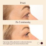 Результати блефаропластики до і після в InSense Clinic (SV Plastic Surgery Clinic), підтяжка повік