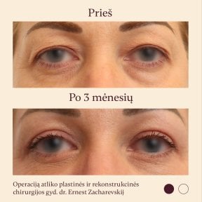 Результати блефаропластики до і після в InSense Clinic (SV Plastic Surgery Clinic), підтяжка повік