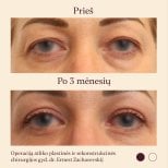 Результати блефаропластики до і після в InSense Clinic (SV Plastic Surgery Clinic), підтяжка повік