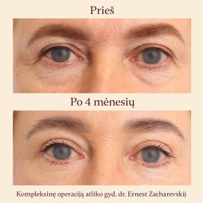 Résultats lifting visage avant/après à InSense Clinic (SV Plastic Surgery Clinic), rajeunissement des yeux