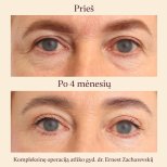 Résultats lifting visage avant/après à InSense Clinic (SV Plastic Surgery Clinic), rajeunissement des yeux