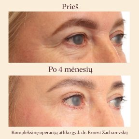 Résultats lifting visage avant/après à InSense Clinic, contour des yeux lissé