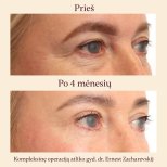Résultats lifting visage avant/après à InSense Clinic, contour des yeux lissé