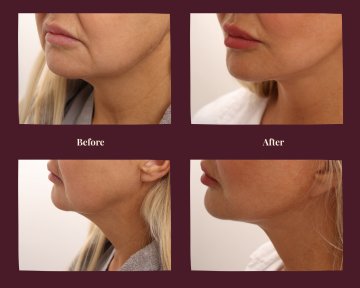 Résultats avant et après lifting du visage à InSense Clinic (SV Plastic Surgery Clinic), ovale raffermi