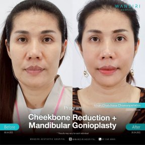 Before and after cheekbone reduction and mandibular gonioplasty results at Wansiri Hospital
