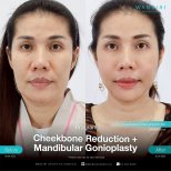 Before and after cheekbone reduction and mandibular gonioplasty results at Wansiri Hospital