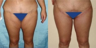 Resultados de abdominoplastia antes y después en Memorial Ankara Hospital, abdomen mejorado