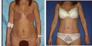 Resultados de abdominoplastia antes y después en Memorial Ankara Hospital – abdomen definido