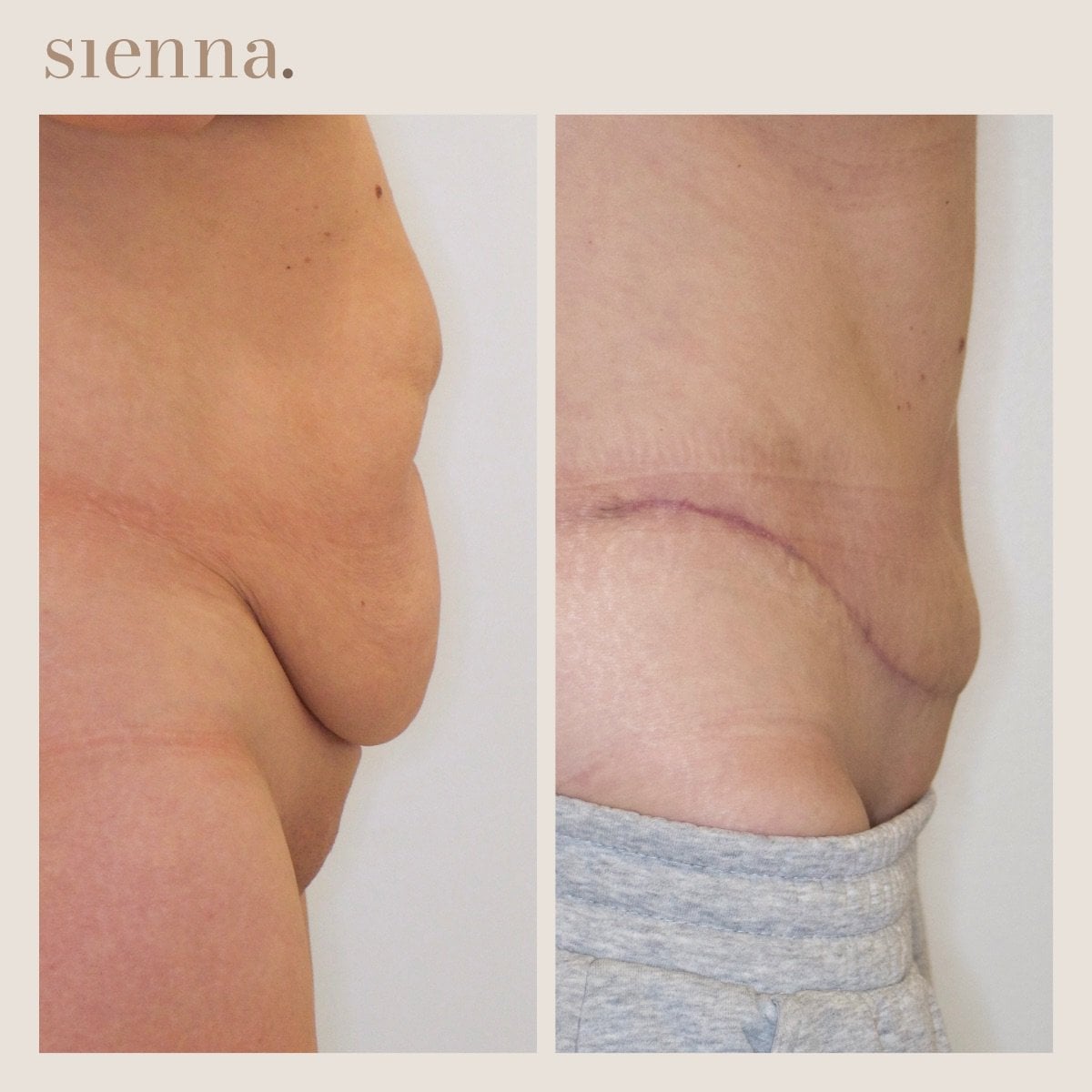 Resultados de abdominoplastia y liposucción antes y después en Sienna Clinic, abdomen mejorado