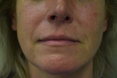 before-after photo podtyazhka-gub