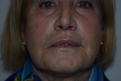 before-after photo podtyazhka-gub