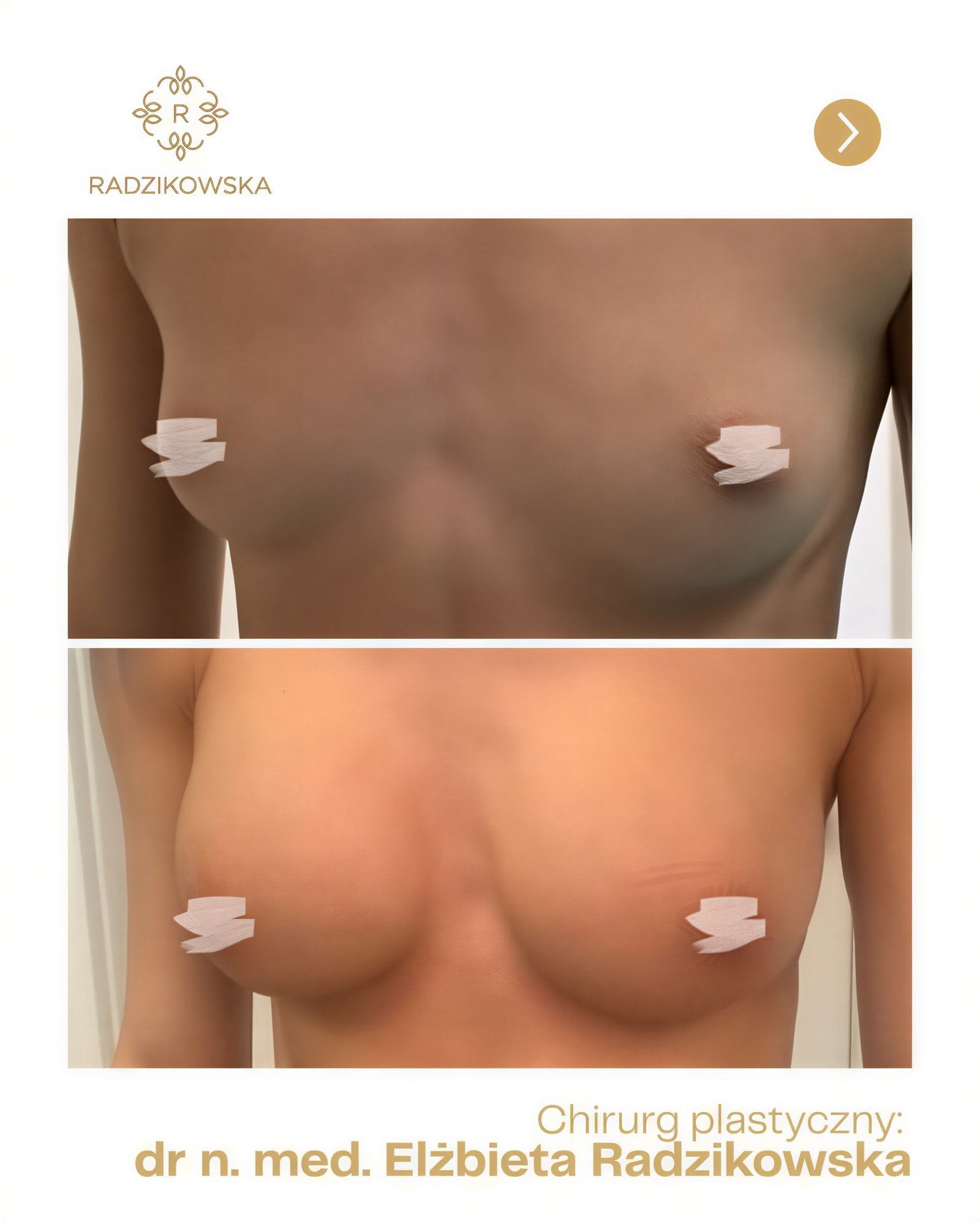 Resultados de aumento de senos antes y después en Radzikowska Clinic, contorno más lleno