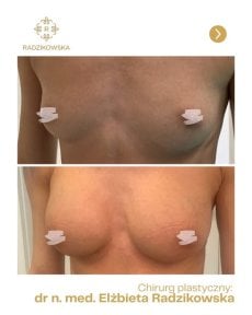 Resultados de aumento de senos antes y después en Radzikowska Clinic, contorno más lleno