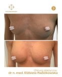 Resultados de aumento de senos antes y después en Radzikowska Clinic, contorno más lleno