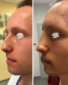 Résultats avant et après rhinoplastie, forme et profil du nez améliorés après chirurgie