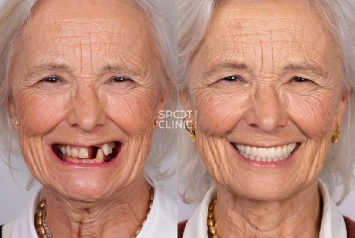 نتيجة ترميم الأسنان (تجميل الأسنان) قبل وبعد في Spot Clinic – تحسين جمالية الابتسامة