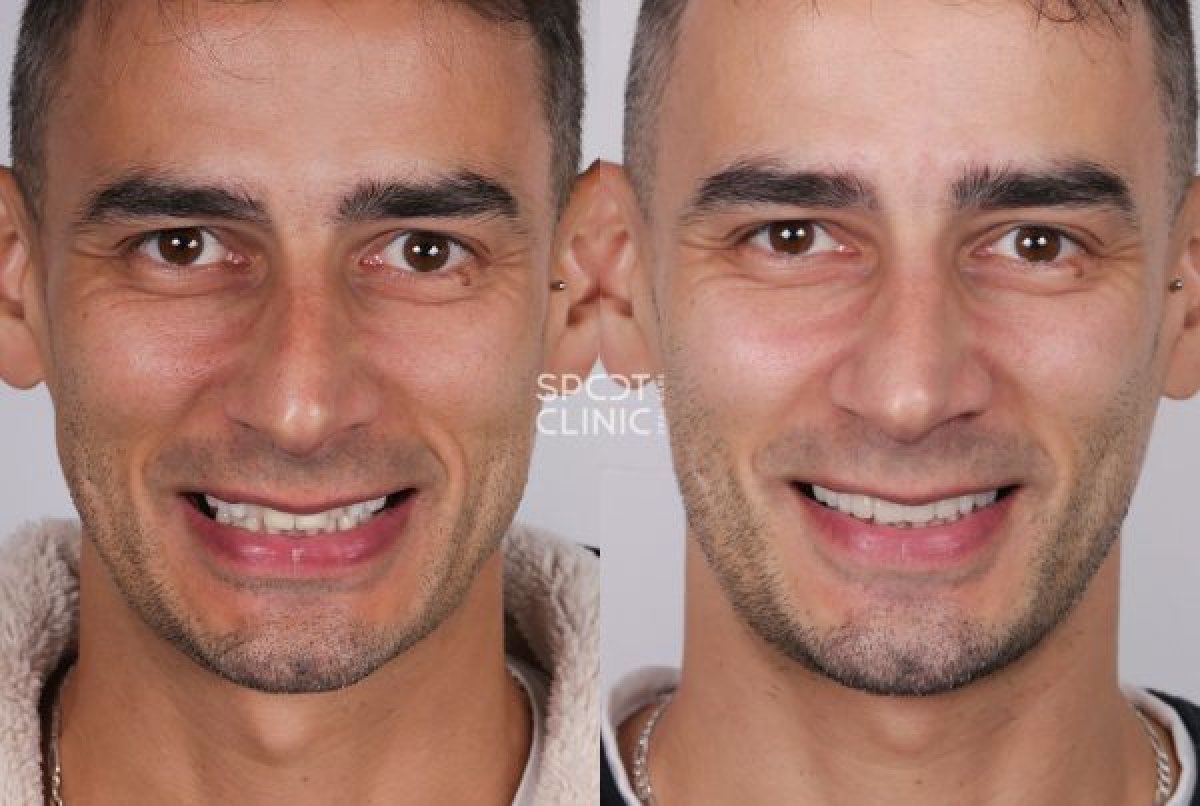 Resultados de blanqueamiento dental antes y después en Spot Clinic – sonrisa más brillante