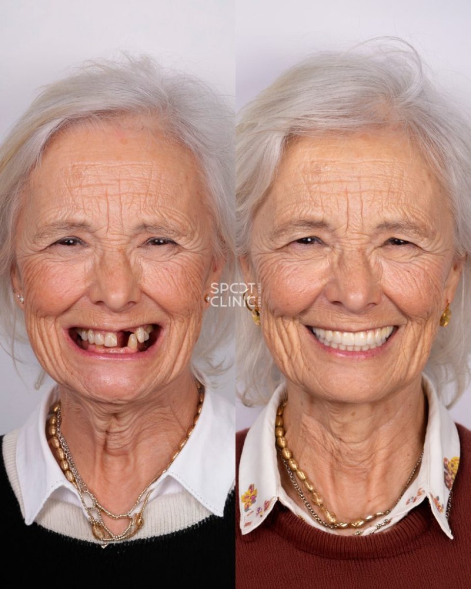 Resultados de prótesis dental antes y después en Spot Clinic – sonrisa restaurada