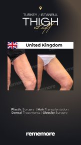 before-after photo thigh-lift