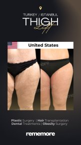 before-after photo thigh-lift