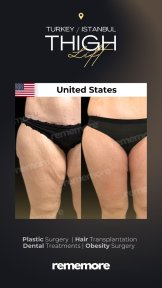 before-after photo thigh-lift