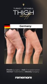 before-after photo thigh-lift
