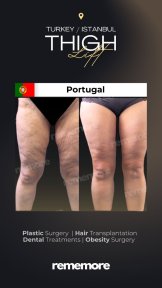before-after photo thigh-lift