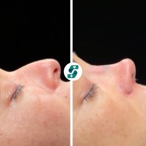 before-after photo rhinoplasty-nose-job