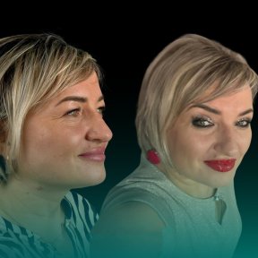 before-after photo blefaroplastika-korrekciya-vek