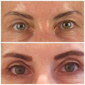 before-after photo blefaroplastika-korrekciya-vek