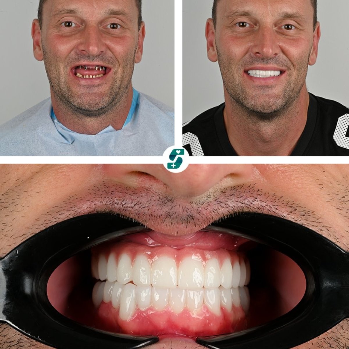 Resultados antes y después de implantes dentales All-on-6 en Soraca Med – sonrisa restaurada