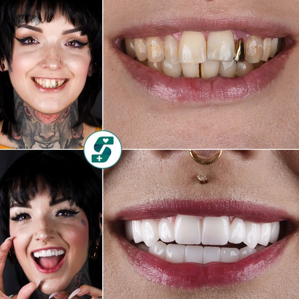 Antes y después de coronas de zirconio en Soraca Med, resultados de transformación de sonrisa