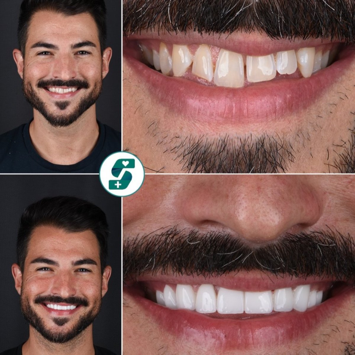 قبل وبعد تركيب تيجان الزركونيا في Soraca Med – نتائج تجميل الابتسامة