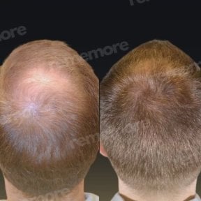 before-after photo hair-transplant