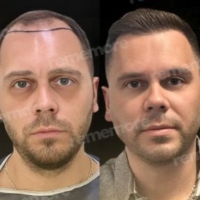 before-after photo hair-transplant