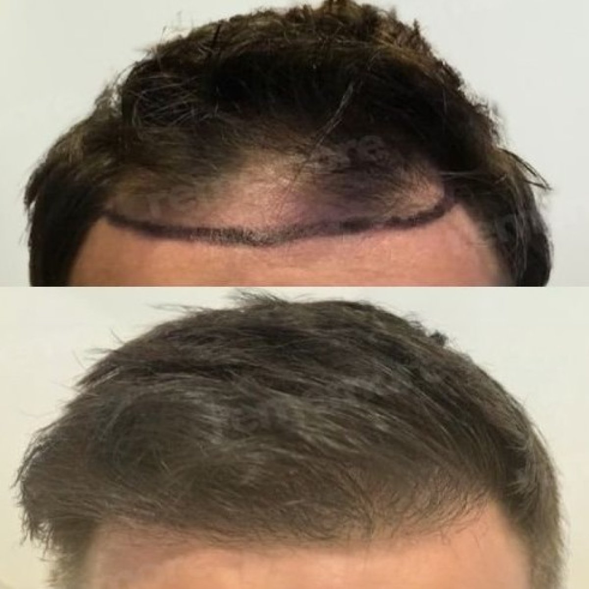 نتائج زراعة الشعر قبل وبعد في مستشفى ميموريال بهجيليفلر، استعادة خط الشعر