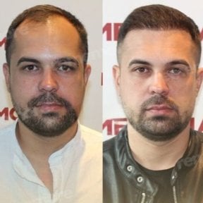 before-after photo hair-transplant